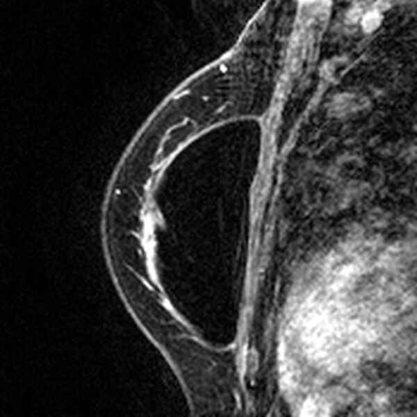 File:Breast implants - MRI (Radiopaedia 26864-27035 Sagittal T2 40).jpg