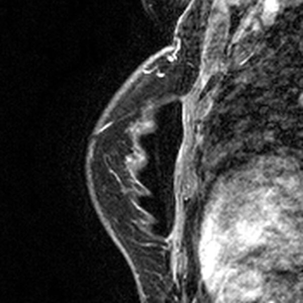 File:Breast implants - MRI (Radiopaedia 26864-27035 Sagittal T2 44).jpg