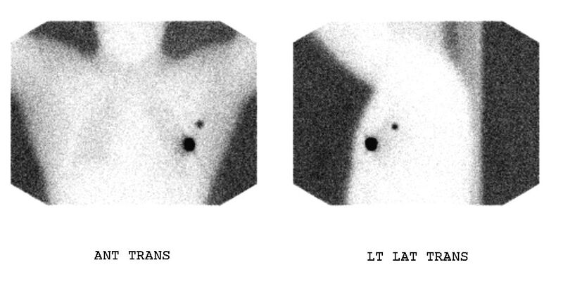 File:Breast lymphoscintigraphy (Radiopaedia 11255).jpg
