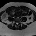 Broad ligament fibroid (Radiopaedia 49135-54241 Axial T2 5).jpg