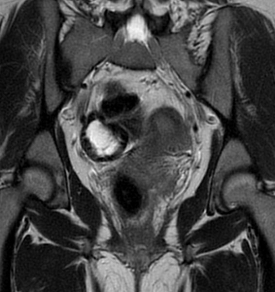 File:Broad ligament leiomyoma (Radiopaedia 81634-95516 Coronal T2 15).jpg