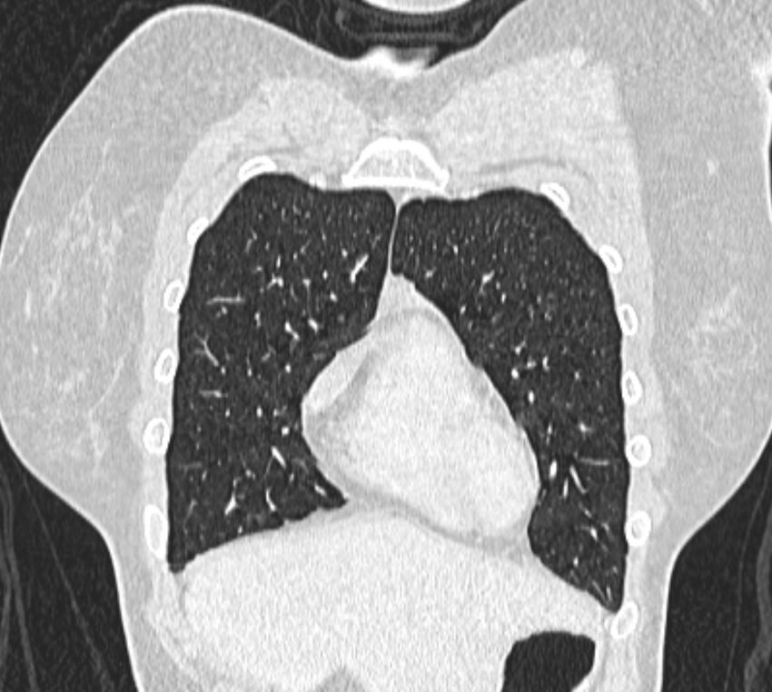 Bronchial atresia (Radiopaedia 50007-55297 Coronal lung window 14).jpg