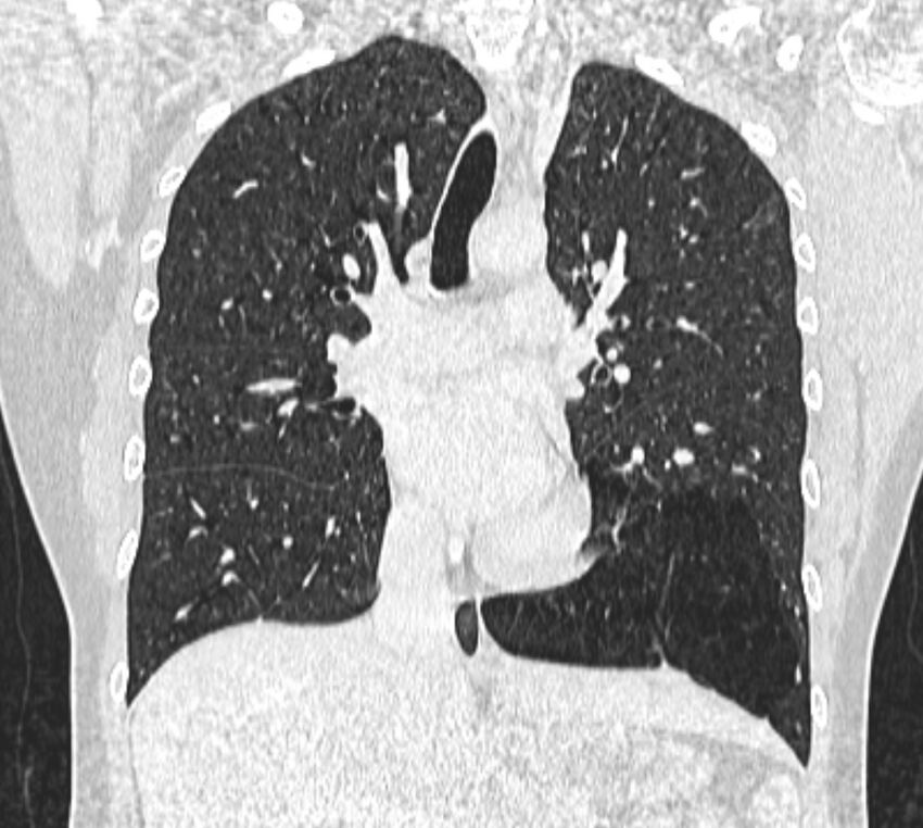 Bronchial atresia (Radiopaedia 50007-55297 Coronal lung window 51).jpg
