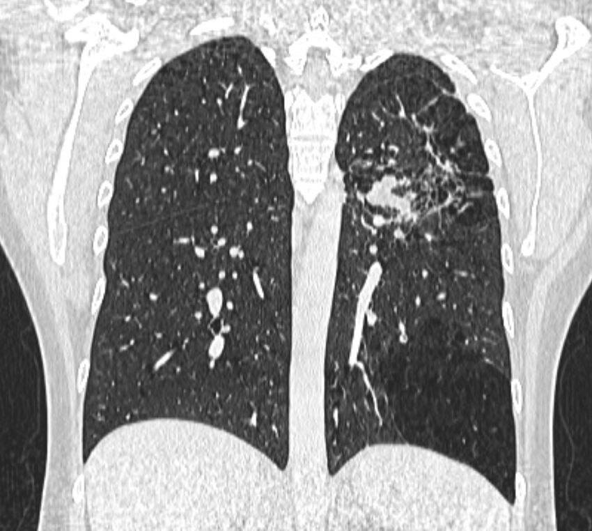 Bronchial atresia (Radiopaedia 50007-55297 Coronal lung window 76).jpg