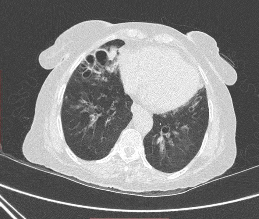 Bronchiectasis (Radiopaedia 72693-83293 Axial lung window 97).jpg