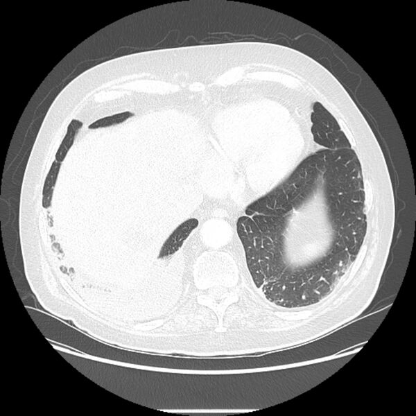 File:Bronchogenic adenocarcinoma and pulmonary embolism (Radiopaedia 9097-9806 Axial lung window 24).jpg