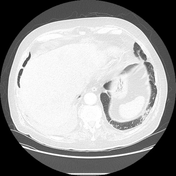File:Bronchogenic adenocarcinoma and pulmonary embolism (Radiopaedia 9097-9806 Axial lung window 25).jpg