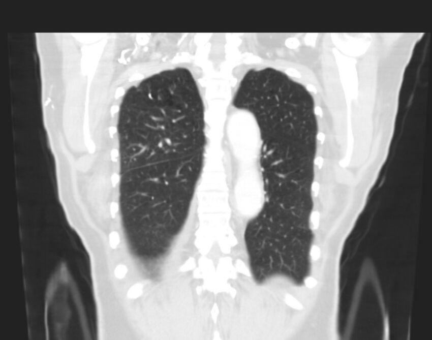 Bronchogenic carcinoma with lymphangitic spread (Radiopaedia 29002-29357 Coronal lung window 57).jpg