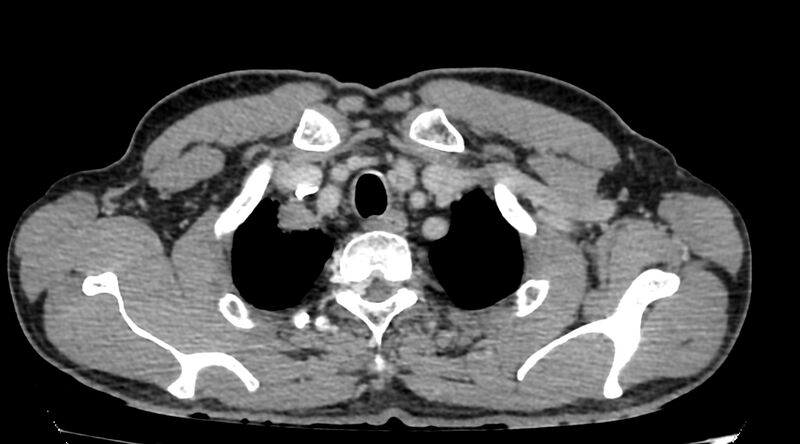 File:Bronchogenic carcinoma with superior vena cava syndrome (Radiopaedia 36497-38054 Axial C+ delayed 4).jpg