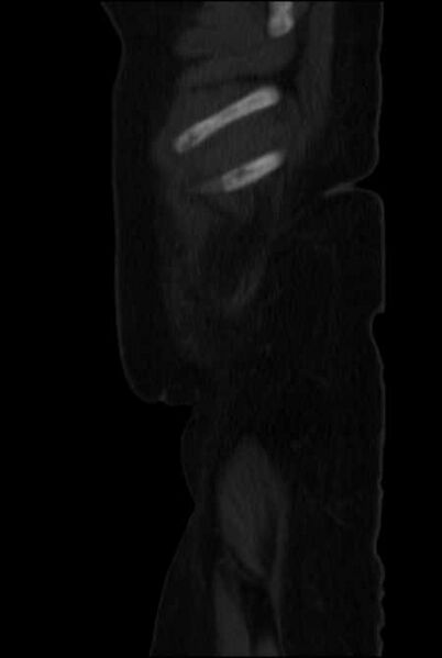 File:Brown tumors compressing the spinal cord (Radiopaedia 68442-77988 H 4).jpg