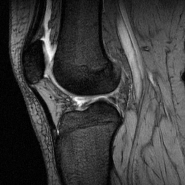 File:Bucket handle tear - medial meniscus (Radiopaedia 79028-91942 D 10).jpg