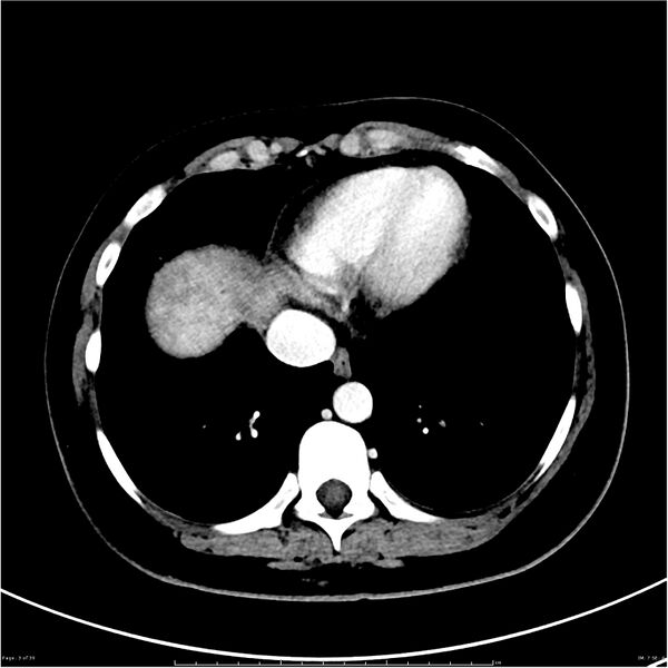 File:Budd-Chiari syndrome (Radiopaedia 27929-28177 Axial liver window 3).JPG