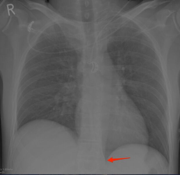 File:Bulging of paraspinal line in traumatic thoracal spinal compression fracture (Radiopaedia 29221-29619 AP 1).jpg