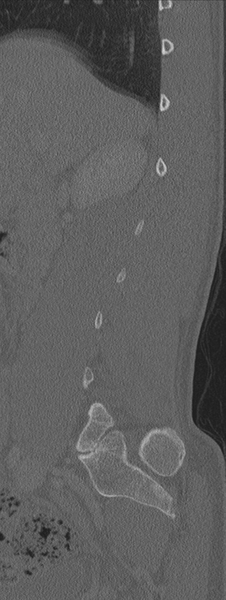 File:Burst fracture - T12 with conus compression (Radiopaedia 56825-63647 Sagittal bone window 68).png