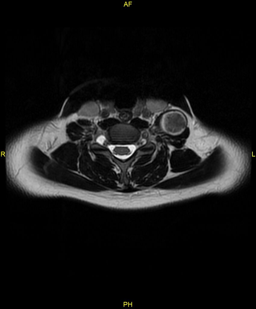 C5 nerve sheath tumor (Radiopaedia 85777-101596 Axial T2 51).jpg
