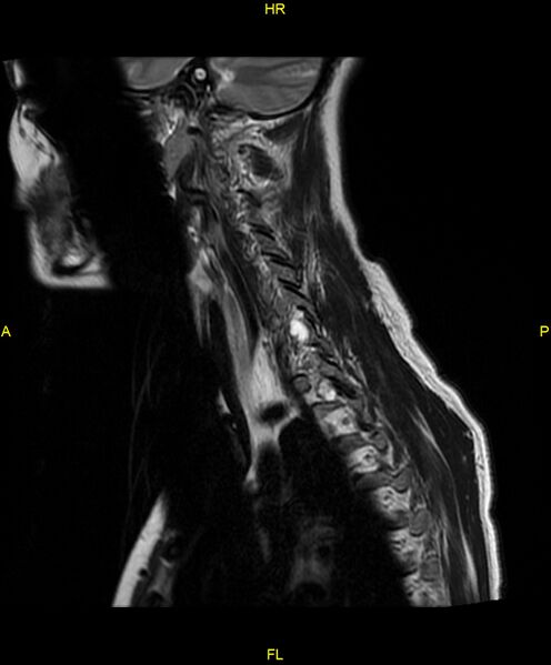 File:C5 nerve sheath tumor (Radiopaedia 85777-101596 Sagittal T2 6).jpg