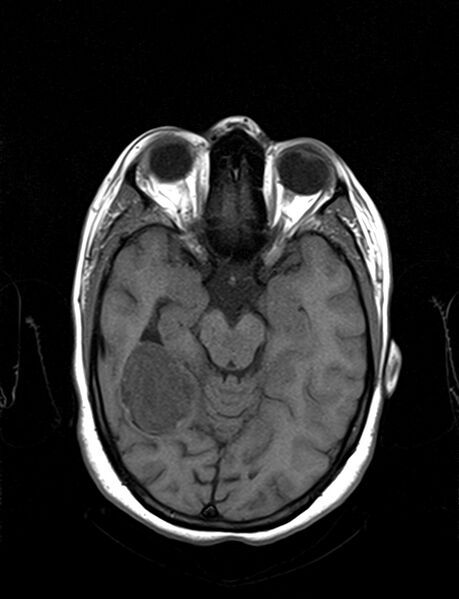 File:Calcified cerebral hydatid cyst (Radiopaedia 65603-74699 Axial T1 9).jpg