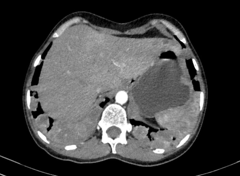 File:Cannonball metastases from breast cancer (Radiopaedia 91024-108569 A 108).jpg