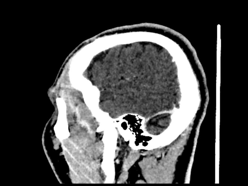 File:Capillary hemangioma of the orbit (Radiopaedia 44610-48358 C 117).jpg