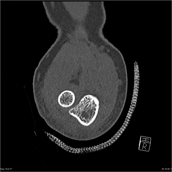 File:Capitellum fracture (Radiopaedia 23352-23426 Coronal bone window 49).jpg