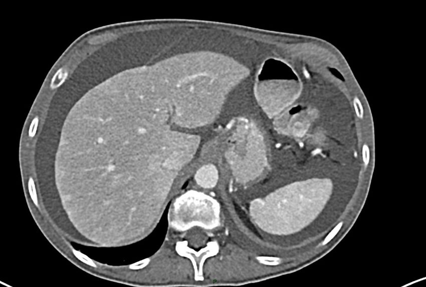 Carcinoid mesenteric tumor complicated by chylous ascites (Radiopaedia 76312-87953 A 13).jpg