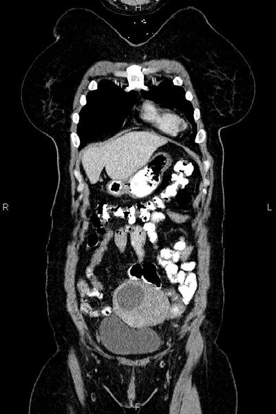 File:Carcinoma of uterine cervix (Radiopaedia 85861-101700 C 6).jpg