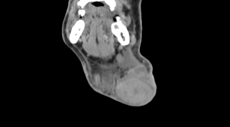 File:Carotid artery pseudoaneurysm (Radiopaedia 84030-99259 D 5).jpg