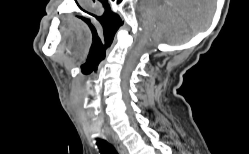 Carotid artery pseudoaneurysm (Radiopaedia 84030-99259 E 8).jpg