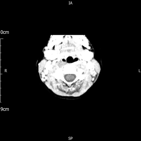 File:Cavernous sinus thrombosis (Radiopaedia 79414-92510 Axial Brain 13).jpg