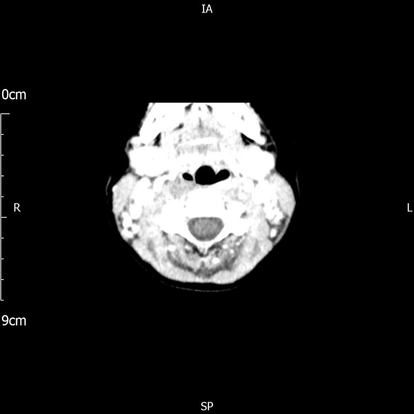 Cavernous sinus thrombosis (Radiopaedia 79414-92510 Axial Brain 13).jpg
