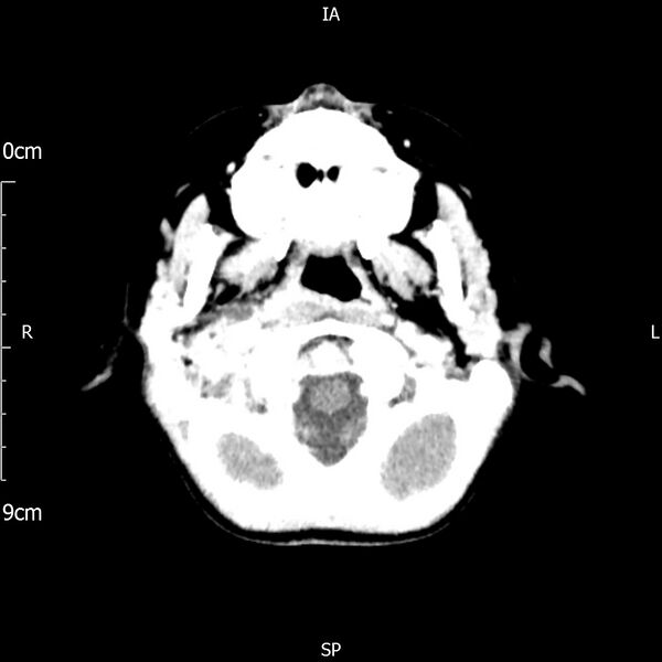 File:Cavernous sinus thrombosis (Radiopaedia 79414-92510 Axial Brain 46).jpg