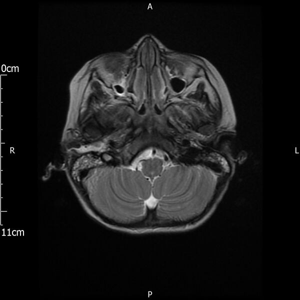 File:Cavernous sinus thrombosis (Radiopaedia 79414-92512 Axial T2 5).jpg