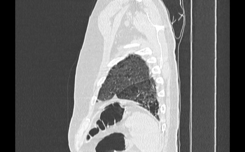 File:Cavitating bronchogenic carcinoma (Radiopaedia 44489-48162 Sagittal lung window 63).jpg