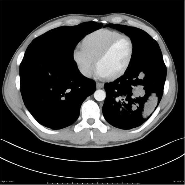 File:Cavitating lung cancer (Radiopaedia 25796-25945 C+ arterial phase 41).jpg