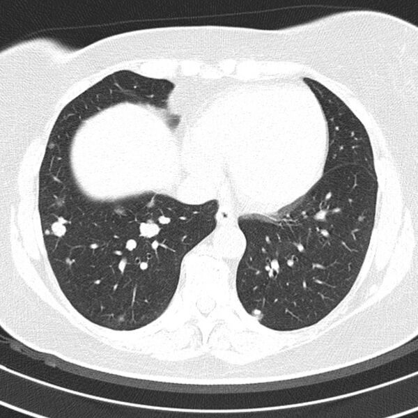 File:Cavitating pulmonary metastases (Radiopaedia 17796-17555 Axial lung window 15).jpg