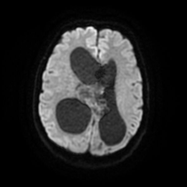 File:Central neurocytoma (Radiopaedia 67618-77021 Axial DWI 14).jpg
