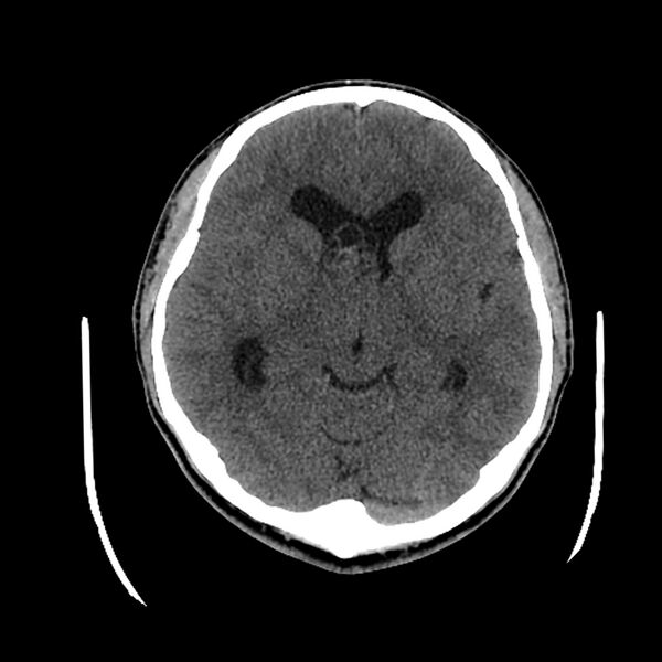 File:Central neurocytoma (Radiopaedia 79320-92379 Axial non-contrast 24).jpg