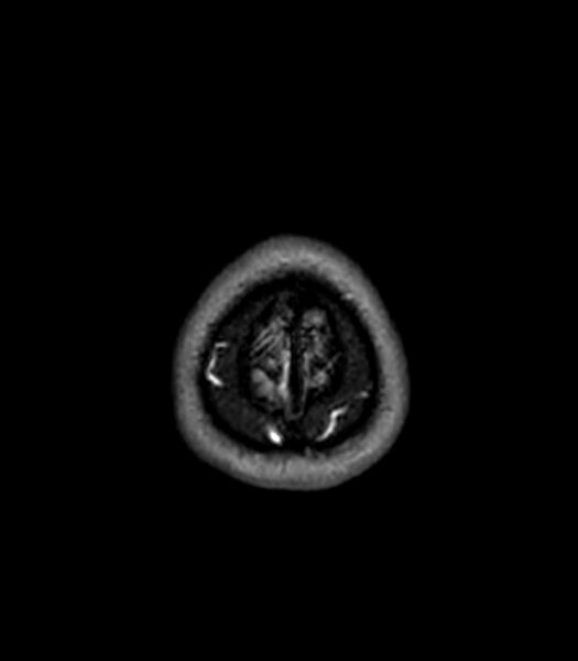 File:Central neurocytoma (Radiopaedia 79320-92380 Axial FLAIR 31).jpg