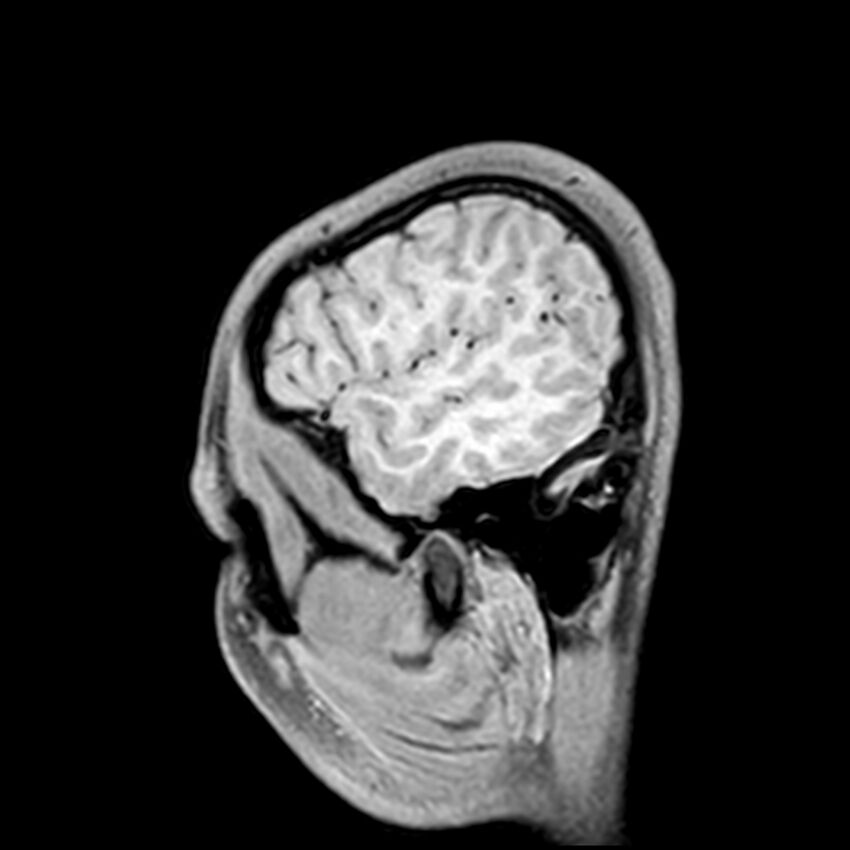 Central neurocytoma (Radiopaedia 79320-92380 Sagittal T1 44).jpg