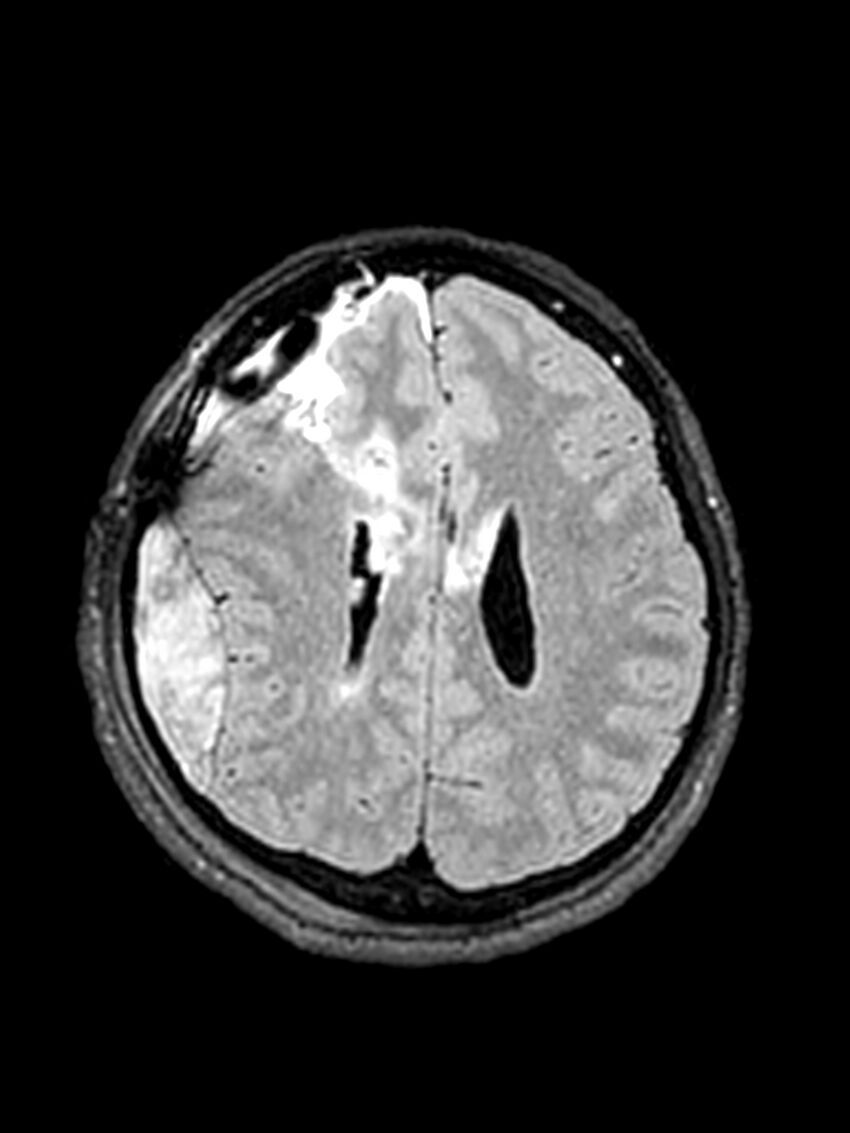 Central neurocytoma (Radiopaedia 79320-92381 Axial FLAIR 62).jpg