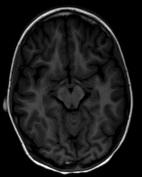 File:Cerebellar abscess (Radiopaedia 73727-84563 Axial T1 15).jpg