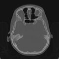 Cerebellar abscess secondary to mastoiditis (Radiopaedia 26284-26413 Axial bone window 73).jpg