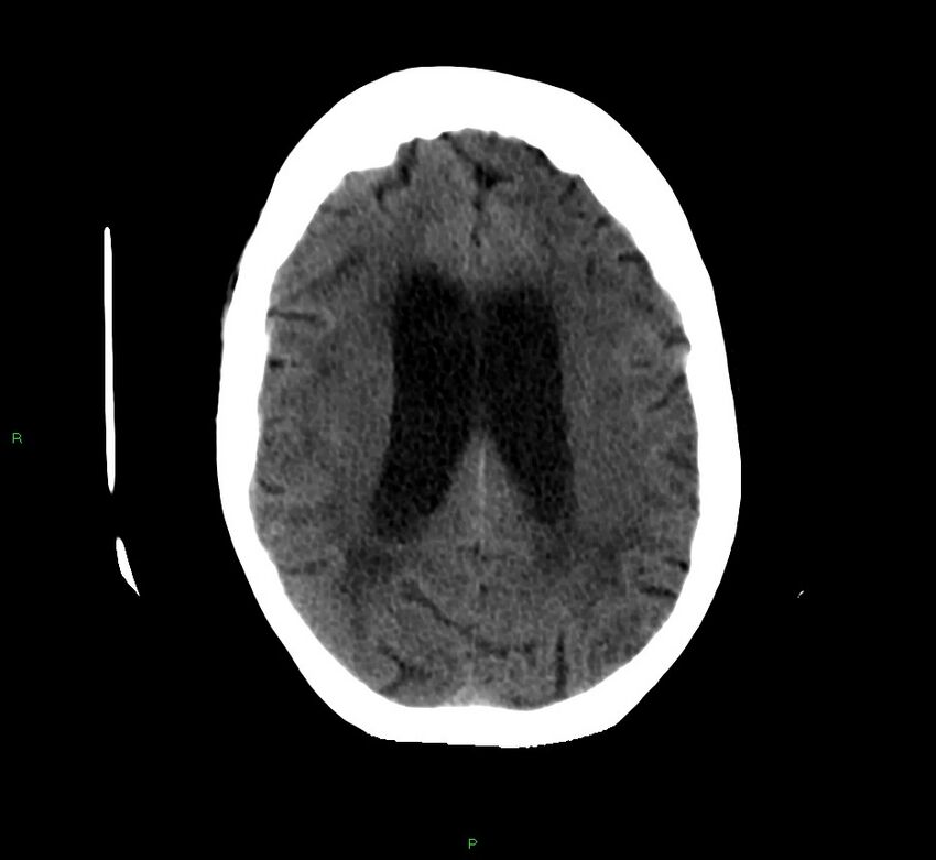 Cerebellar hemorrhage (Radiopaedia 58792-66026 Axial non-contrast 19).jpg