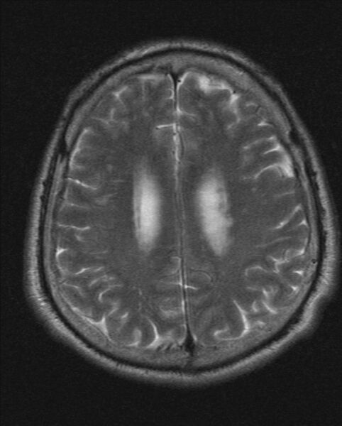 File:Cerebellopontine angle meningioma (Radiopaedia 24459-24764 Axial T2 17).jpg