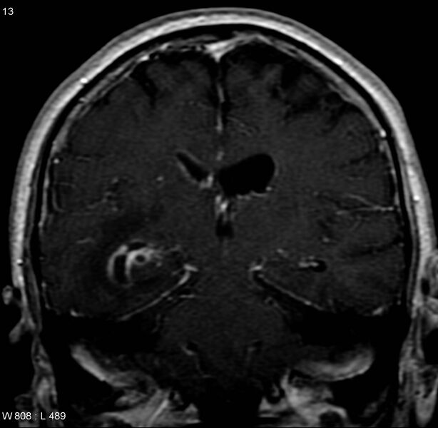 File:Cerebral abscess and ventriculitis (Radiopaedia 5024-6885 Coronal T1 C+ 5).jpg