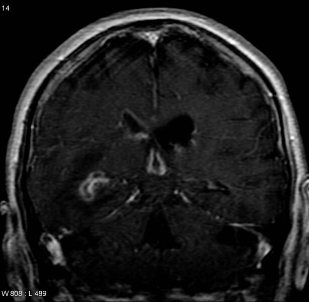 File:Cerebral abscess and ventriculitis (Radiopaedia 5024-6885 Coronal T1 C+ 6).jpg