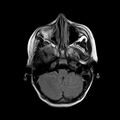 Cerebral abscess post cardiac surgery (Radiopaedia 27244-27420 Axial FLAIR 4).jpg