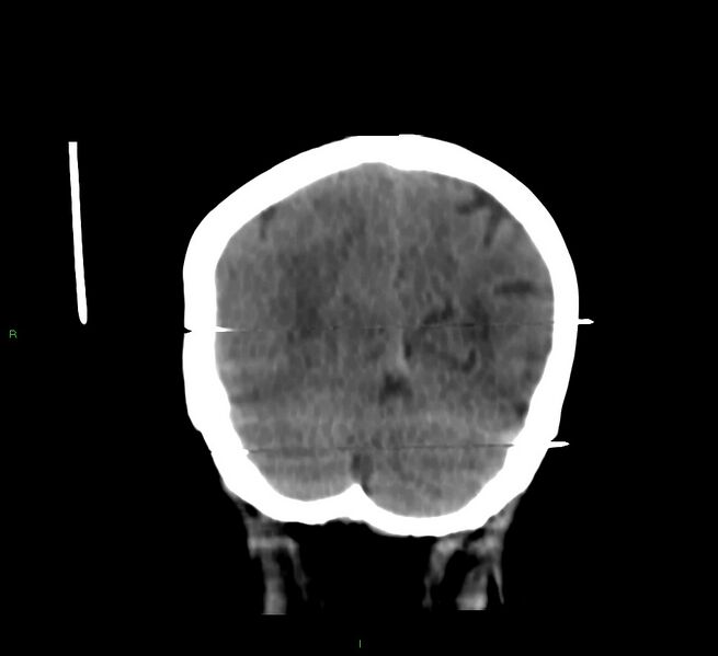 File:Cerebral amyloid angiopathy-associated lobar intracerebral hemorrhage (Radiopaedia 58377-65514 Coronal non-contrast 16).jpg