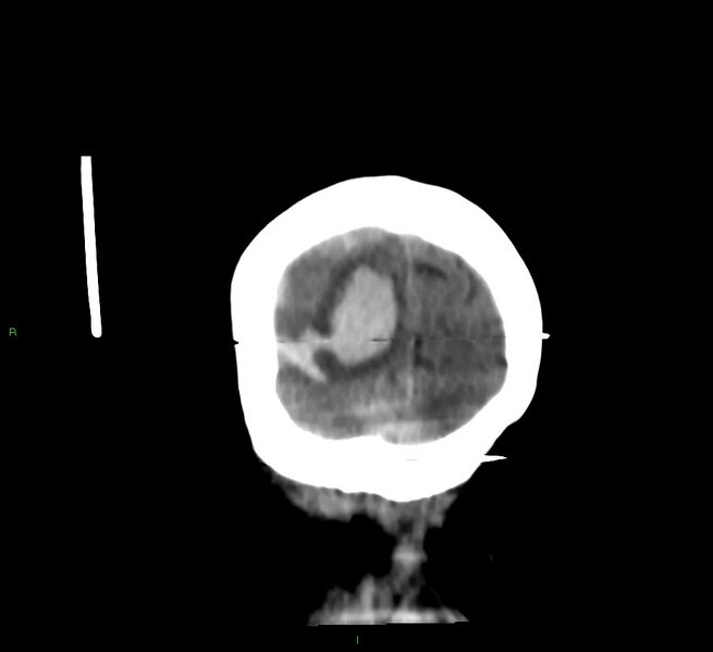 File:Cerebral amyloid angiopathy-associated lobar intracerebral hemorrhage (Radiopaedia 58377-65514 Coronal non-contrast 9).jpg