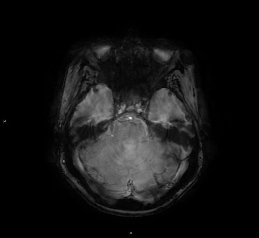 Cerebral amyloid angiopathy-associated lobar intracerebral hemorrhage (Radiopaedia 58378-65517 Axial SWI 22).jpg